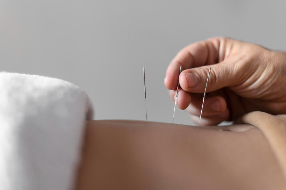 Acupuncture in Winter Park FL